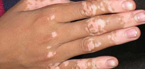 صورة: ظهور البقع البيضاء و أسباب ظهور بقع بيضاء على اليدين