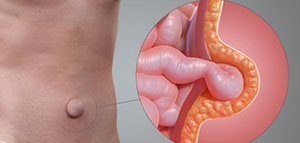 صورة: تعريف الفتق و أنواع الفتق و الفتق الإربي