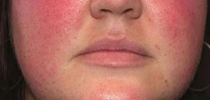 صورة: احمرار الوجه وسخونته و أسباب احمرار الوجه وسخونته