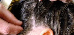 صورة: الخل الأبيض و زيت جوز الهند مع عصير الليمون