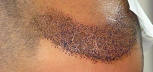 زراعة الشعر صورة: زراعة الشعر