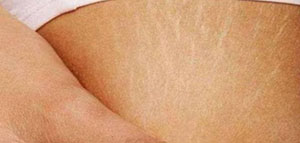 صورة: تشققات البطن و أسباب تشققات البطن و مواضع التشققات في البطن[d]25