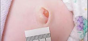 فتق السرة و أسباب فتق السرة و أعراض فتق السرة صورة: فتق السرة و أسباب فتق السرة و أعراض فتق السرة