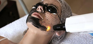 التقشير الكربوني و طريقة التقشير الكربوني صورة: التقشير الكربوني و طريقة التقشير الكربوني