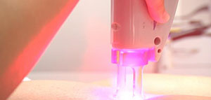 صورة: كريمات إزالة الشعر و التحليل الكهربائي