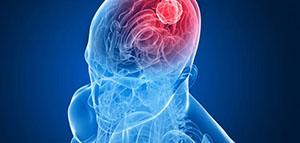 صورة: سرطان الدماغ
