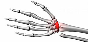 أنواع كسور العظام و الأسباب التي تزيد من احتمالية حدوث الكسور صورة: أنواع كسور العظام و الأسباب التي تزيد من احتمالية حدوث الكسور