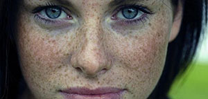 صورة: الكلف و علاج الكلف و فيديو عن علاج الكلف