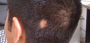 أمراض فروة الرأس و أمراض تؤدي إلى تساقط الشعر صورة: أمراض فروة الرأس و أمراض تؤدي إلى تساقط الشعر