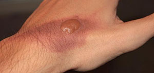 آثار حروق الدرجة الأولى و الوقاية من الحروق المنزلية صورة: آثار حروق الدرجة الأولى و الوقاية من الحروق المنزلية