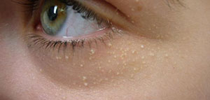 أسباب وعوامل ظهور حبوب بيضاء في الوجه و أسباب أخرى لا علاقة لها بحب الشباب صورة: أسباب وعوامل ظهور حبوب بيضاء في الوجه و أسباب أخرى لا علاقة لها بحب الشباب