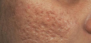 علاج آثار الحبوب بالوصفات المنزلية صورة: علاج آثار الحبوب بالوصفات المنزلية