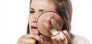 صورة: بقع الحبوب و طرق إزالة بقع الحبوب من الوجه