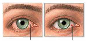 صورة: اصفرار العين و أسباب اصفرار العين و مضاعفات اصفرار العين