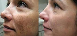 الكلف و أسباب الكلف و وصفات طبيعية لإزالة الكلف صورة: الكلف و أسباب الكلف و وصفات طبيعية لإزالة الكلف