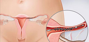 الولادة القيصرية و زيادة الوزن بعد الولادة القيصرية صورة: الولادة القيصرية و زيادة الوزن بعد الولادة القيصرية