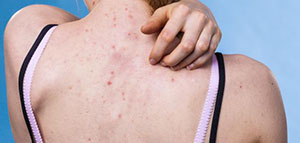 صورة: حبوب الظهر وآثارها و التخلص من آثار الحبوب في الظهر