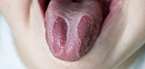 فطريات الفم و علامات وأعراض فطريات الفم صورة: فطريات الفم و علامات وأعراض فطريات الفم