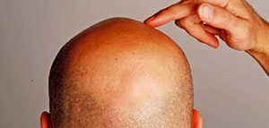 صورة: خلل الهرمونات و علاج خلل الهرمونات و أعراض خلل الهرمونات