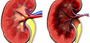 تليف الكلى و علاج تليف الكلى و أعراض مرض الكلى المزمن صورة: تليف الكلى و علاج تليف الكلى و أعراض مرض الكلى المزمن