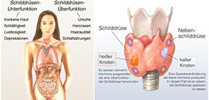 الغدة الدرقية و الغدة الدرقية وتساقط الشعر صورة: الغدة الدرقية و الغدة الدرقية وتساقط الشعر
