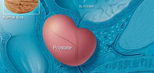 تضخم البروستات و أعراض تضخم البروستات صورة: تضخم البروستات و أعراض تضخم البروستات