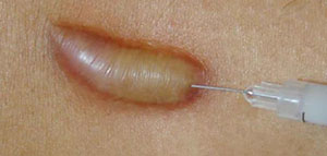 صورة: الكورتيزون الموضعي و مضاعفات استخدام الكورتيزون الموضعي وآثاره الجانبية