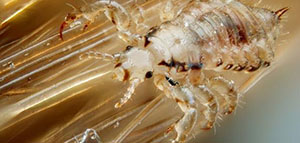 صورة: بيض القمل و وصفات طبيعية للتخلص من بيض القمل