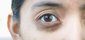 الليزر و الطرق الطبيعية و نصائح للتخلص من الهالات السوداء صورة: الليزر و الطرق الطبيعية و نصائح للتخلص من الهالات السوداء