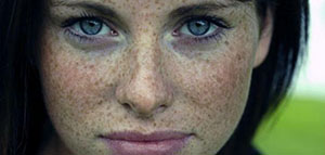 صورة: الطرق الوقائية لعلاج النمش و طرق علاج النمش