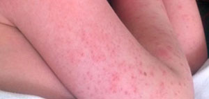 الطفح الجلدي و أسباب ظهور الطفح الجلدي على الجسم صورة: الطفح الجلدي و أسباب ظهور الطفح الجلدي على الجسم
