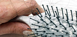 صورة: تساقط الشعر و كيفية إيقاف تساقط الشعر