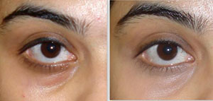 العين و الهالات السوداء صورة: العين و الهالات السوداء