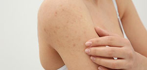 صورة: أدوية حبوب الشباب الموضعية و لاصقات الحبوب