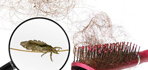 مشط القمل و الثوم و خل التفاح و زيت بذور السمسم صورة: مشط القمل و الثوم و خل التفاح و زيت بذور السمسم