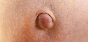 الفتق السري و علاج الفتق السري و الفتق الجنب السري صورة: الفتق السري و علاج الفتق السري و الفتق الجنب السري