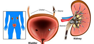 أعراض حصى الحالب و أسباب حصى الحالب وعوامل الخطر صورة: أعراض حصى الحالب و أسباب حصى الحالب وعوامل الخطر