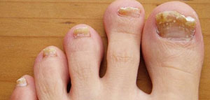 صودا الخبز و زيت شجرة الشاي و زيت الزيتون صورة: صودا الخبز و زيت شجرة الشاي و زيت الزيتون