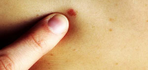 صورة: البقع الحمراء على الجسم و أسباب البقع الحمراء على الجسم