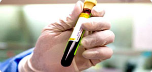 تحليل CBC و ماذا يقيس تحليل CBC و الحالات التي تستدعي إجراء تحليل CBC صورة: تحليل CBC و ماذا يقيس تحليل CBC و الحالات التي تستدعي إجراء تحليل CBC