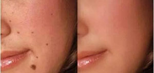 صورة: الشامات و أسباب ظهور الشامات و طرق طبية لإزالة الشامات من الوجه