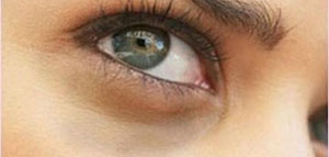 صورة: الهالات السوداء و أسباب ظهور الهالات السوداء[d]24