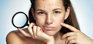 صورة: حب الشباب و الحل النهائي لحب الشباب