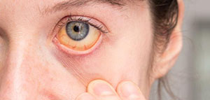 صورة: أبو صفار عند الحامل و أعراض أبو صفار عند الحامل