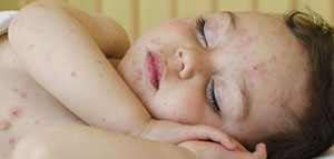 حمو النيل و القضاء على حمو النيل عند الأطفال صورة: حمو النيل و القضاء على حمو النيل عند الأطفال