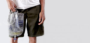 صورة: أنواع قسطرة البول و اختيار نوع القسطرة المناسب