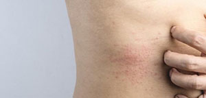 البشرة الجافة وأعراضها و العوامل التي تسبب جفاف البشرة صورة: البشرة الجافة وأعراضها و العوامل التي تسبب جفاف البشرة