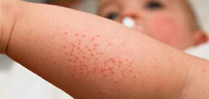 الأطفال و أسباب ظهور حبوب حمراء عند الأطفال صورة: الأطفال و أسباب ظهور حبوب حمراء عند الأطفال