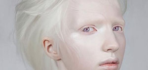 صورة: صبغة الجلد و نقص صبغة الجلد