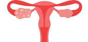 أعراض تكيس المبايض و هل يؤثر تكيس المبايض على الحمل صورة: أعراض تكيس المبايض و هل يؤثر تكيس المبايض على الحمل